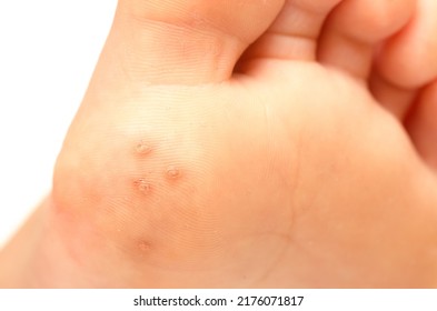 Closeup Of Plantar Warts Under Foot Of A Child Caused By HPV (human Papillomavirus)