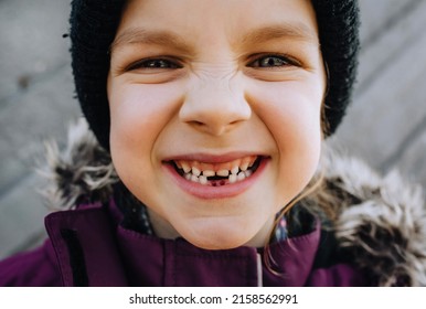 Close-up Portrait Of A Beautiful, Cheerful, Smiling And Toothless Girl, A Child Of Preschool Age After An Operation At The Dentist In Dentistry.