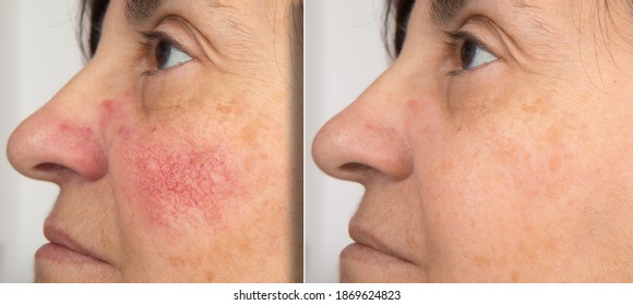 A close-up portrait of before and after a mature woman showing redness on her cheeks. The concept of rosacea. High quality photo