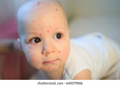 Chickenpox Images Stock Photos Vectors Shutterstock