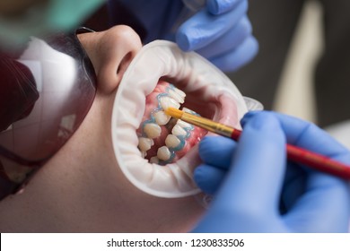 Close-up Portrait Of A Female Patient At Dentist In The Clinic. Hollywood Smile Veneers. Dentist In A Disposable Uniform In A Modern Dental Clinic