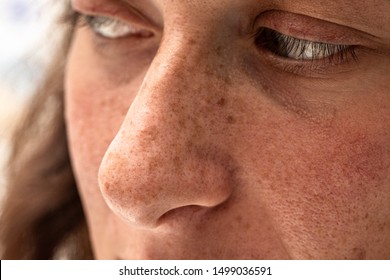 A Closeup Portrait Of A Thirty Year Old Caucasian Girl, Macro Details Of Freckles And Sun Spots Around The Nose And Cheeks, Damage From Harmful Sun Rays.