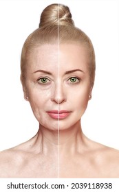 Beautiful Woman Before After Biorevitalization Cosmetic Stock Photo 