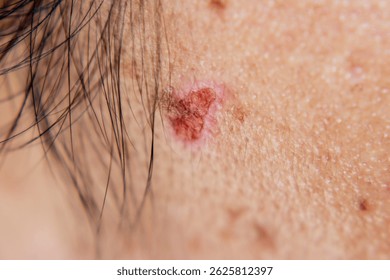 Close-up of a potential skin lesion on a person's face. Could represent basal cell carcinoma, seborrheic keratosis, or a mole. Medical dermatology.