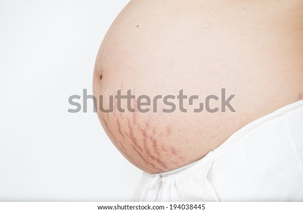 Closeup Pregnant Belly Stretch Marks Isolated Stock Photo Edit Now   Closeup Pregnant Belly Stretch Marks 600w 194038445 