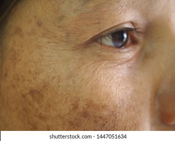 Closeup Problem Wrinkles Dark Spots Melasma Pigmentation Skin On Face Asian Woman. Problem Skincare And Health Concept. 