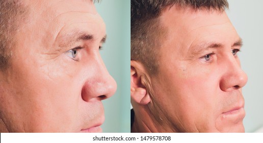 Close-up of procedure for face lifting PDO Suture operation, face lifting surgery. innovative technique of New thread lift, NovaThreads and Silhouette InstaLift men's bags under the eyes.