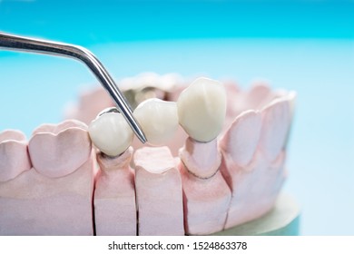 Closeup / Prosthodontics Or Prosthetic / Crown And Bridge Equipment And Model Express Fix Restoration.