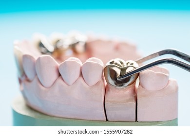 Closeup / Prosthodontics Or Prosthetic / Crown And Bridge Equipment And Model Express Fix Restoration.