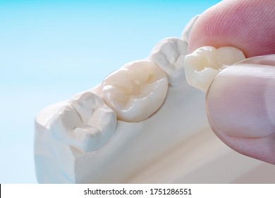 Closeup / Prosthodontics Or Prosthetic / Single Teeth Crown And Bridge Equipment Model Express Fix Restoration.