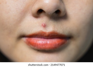 Close-up of Purulent inflamed acne skin on the face of an asian woman