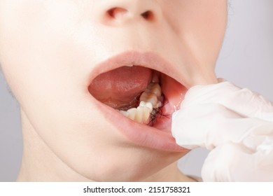 Closeup Of Recession Site Of Dental Gum In Females Mouth After Sergery One Day After. Consept Of Gum Grafting Plastic Surgery Procedure Process, Surgical Gum Plastic.