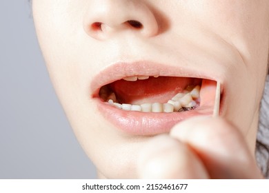 Closeup Of Recession Site Of Dental Gum In Females Mouth After Sergery One Day After. Consept Of Gum Grafting Plastic Surgery Procedure Process, Surgical Gum Plastic.