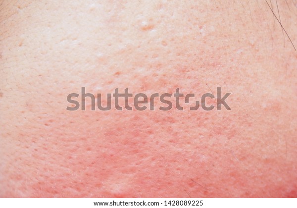 Closeup of red skin with acne, pores and moles on\
the face of a young Asian man face. Health, medical, beauty,\
aesthetics concept