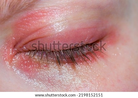 A close-up of the reddened eyelids an allergic reaction
