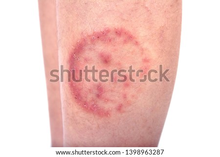 Closeup of ringworm infection or Tinea corporis on skin isolated on white background,  Dermatophytosis on skin isolated