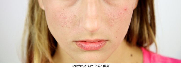closeup of ruined young skin full of spot - Shutterstock ID 286511873