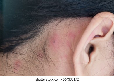 Closeup S Back Neck Full Blistersscar Stock Photo (Edit Now) 577348336