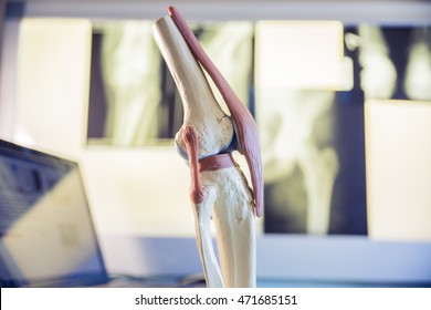 Closeup Scale Model The Layout Of The Artificial Knee Joint In X-ray Leg And Knee