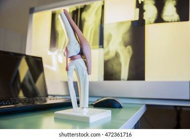 Closeup Scale Model The Layout Of The Artificial Knee Joint In X-ray Leg And Knee