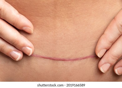 Closeup of scar after C-Section surgery on female belly - Shutterstock ID 2019166589