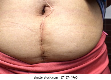 Close-up  Of The Scar On The Abdomen From Surgery