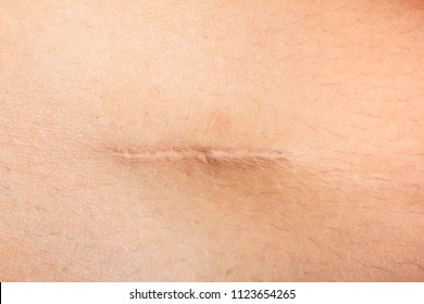 
Closeup of Scars