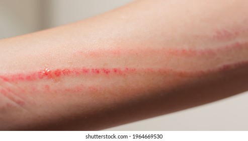 Close-up Of Scratch Marks On A Woman Hand