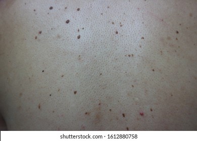 Close-up Seborrheic Keratosis Is A Non-cancerous Tumor. Looks Like Small Skin Like Warts Raised From The Skin. Often Found On The Face, Chest, Shoulders And Back, Does Not Cause Medical Pain.