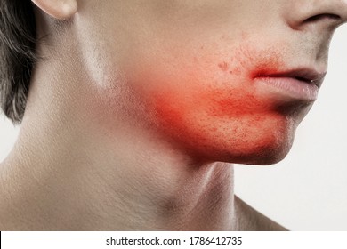 Closeup Of A Sensitive Skin Irritation After A Shaving Routine