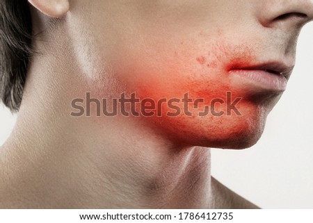 Closeup of a sensitive skin irritation after a shaving routine