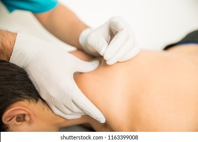Closeup of shirtless man receiving dry needling therapy from doctor in clinic
