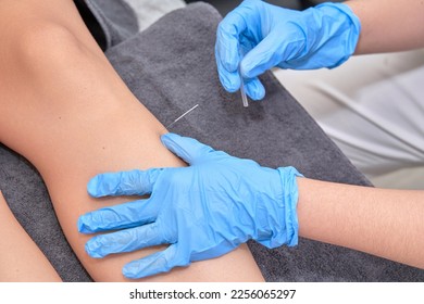 Close-up of shirtless man receiving dry needling therapy from physician in clinic Close-up of physiotherapist performing dry needling treatment on leg. Injury recovery procedure  - Shutterstock ID 2256065297