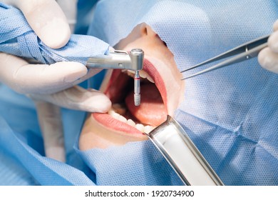 Nahaufnahme von aufmerksamen Ärzten, die chirurgische Eingriffe durchführen und in der modernen Zahnklinik Zahnimplantate in den Mund des Patienten einsetzen. Zahninstrumente. Klinik für Stomatologie. Zahnchirurgie.