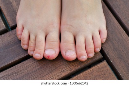 Close-up Shot Of Bad Behavior Or Habit Of Biting Toes. Refer As Stress, Anxiety, Worry And Health Issue. All Kids Toes Are Bitten And Pinky Nail Is Bleeding