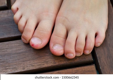 Close-up Shot Of Bad Behavior Or Habit Of Biting Toes. Refer As Stress, Anxiety, Worry And Health Issue. All Kids Toes Are Bitten And Pinky Nail Is Bleeding