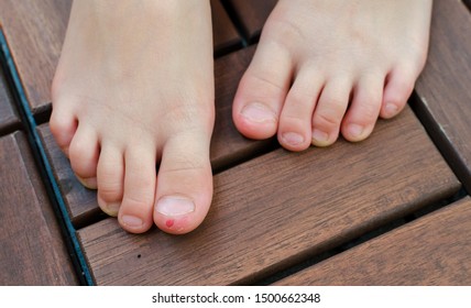 Close-up Shot Of Bad Behavior Or Habit Of Biting Toes. Refer As Stress, Anxiety, Worry And Health Issue. All Kids Toes Are Bitten And Pinky Nail Is Bleeding