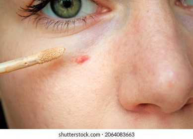 Close-up Shot, Covering Pimple With Concealer. Even Out Skin Tone. 