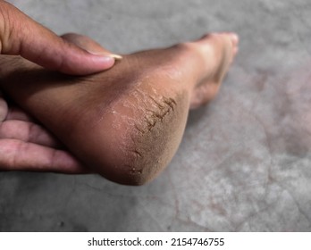 A Closeup Shot Of Cracked  Ankles Photos Background Blue