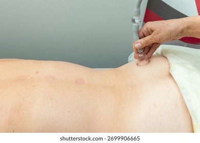 A close-up shot of a person's back while undergoing a vacuum therapy treatment with a small, clear suction cup, highlighting the red marks left by the procedure.