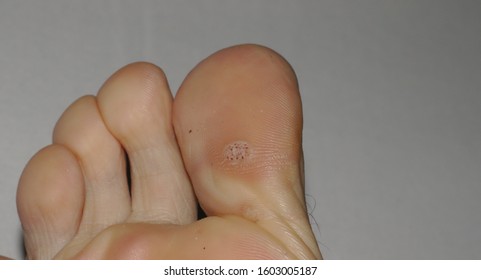 Close-up shot of a plantar wart on the bottom of the big toe caused by the human papillomavirus, or HPV.