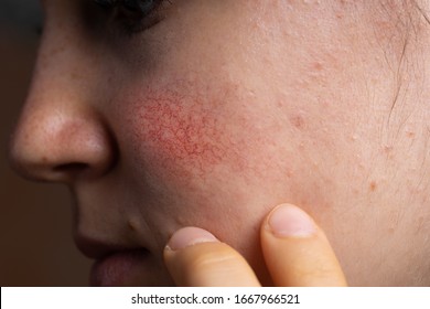 Closeup Shot Of Rosacea Redness On The Cheek Skin Of A Young Woman