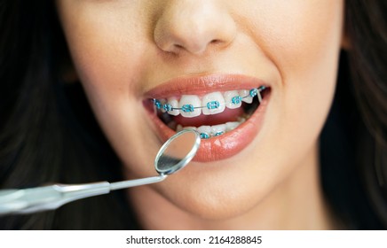 Closeup Shot, Young Woman Mouth With Dental Braces, Dentist Holding Mirror Tool. Mouth Shot 