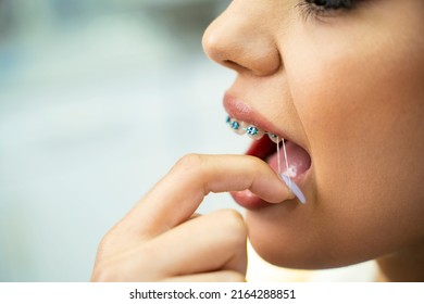 Closeup Shot, Young Woman Putting Rubber Band On Dental Brackets With Her Finger