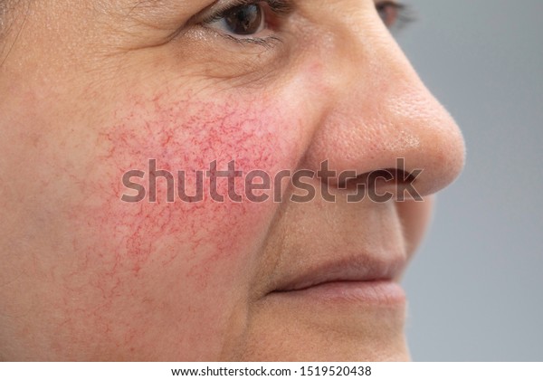 A\
closeup and side profile view of a mature caucasian woman, red and\
blotchy cheeks are seen in detail, the main symptom of rosacea, can\
be treated with topical creams or laser\
surgery.