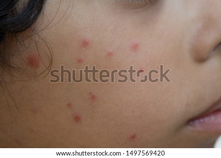 A closeup and side view on the face of a young child, sick and unwell with chickenpox (varicella zoster virus) a highly contagious disease common in youngsters.