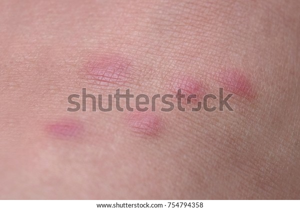 Closeup Skin Allergy Insect Bite Mosquito Stock Photo Edit Now 754794358
