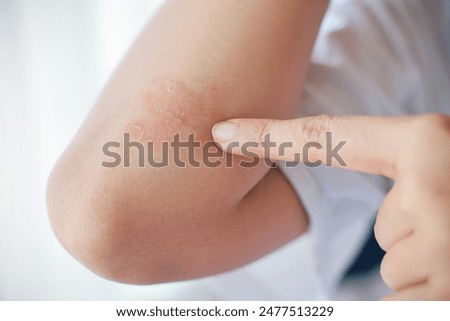 Similar – Image, Stock Photo Psoriasis skin with red wounds. Male arms with cracked, hard, horny, flaky skin. Dermatological problems of allergy, eczema. Hand stains, rash, dry skin. The concept of chronic disease treatment