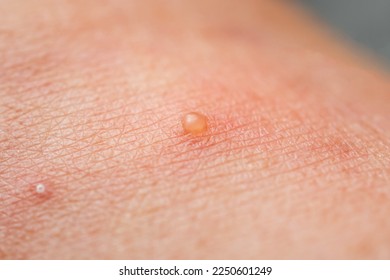 Closeup skin with Dyshidrotic Eczema , skin disease problems - Shutterstock ID 2250601249