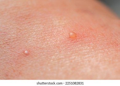 Closeup skin with Dyshidrotic Eczema , skin disease problems - Shutterstock ID 2251082831